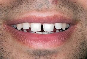 Bullitt Dental, PLLC | Fluoride Treatment, Dental Fillings and Teeth Whitening